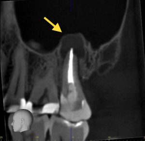 root canal XRay